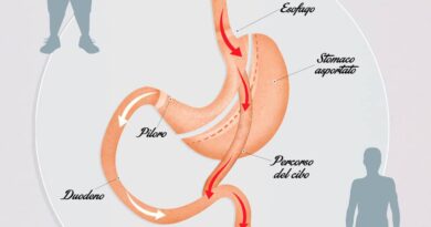 Un schéma décrivant le fonctionnement de l'opération bypass gastrique