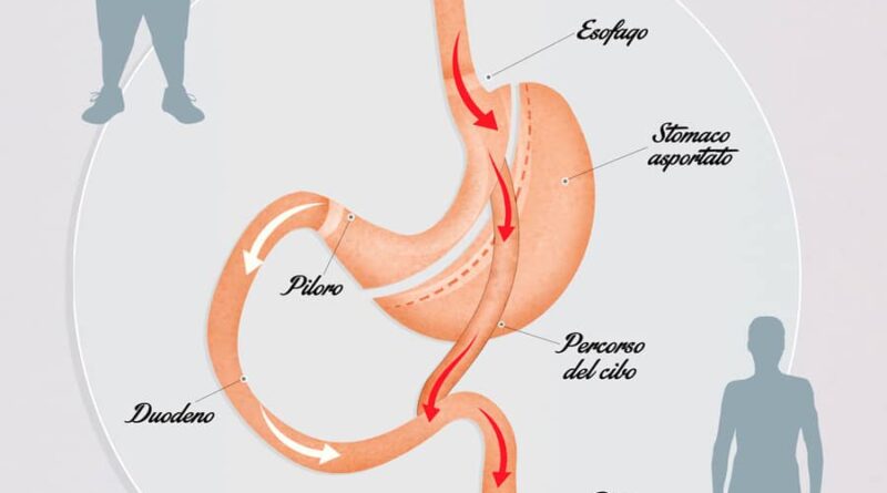 Un schéma décrivant le fonctionnement de l'opération bypass gastrique